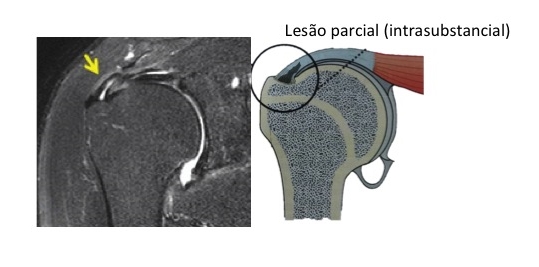 lesão parcial intrasubstancial