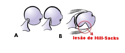 Desenho esquemático mostrando a lesão de Hill-Sacks. a) ombro luxado; b) ombro em posição normal (reduzido) após a luxação