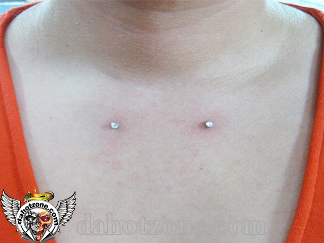 Chest Microdermal