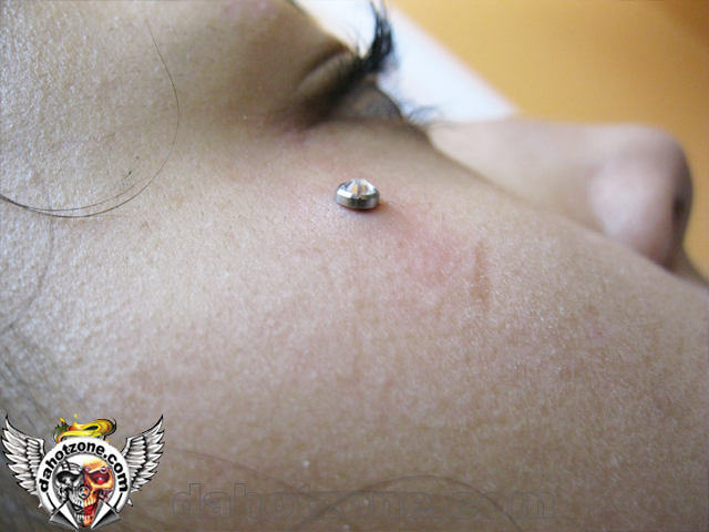 Face microdermal