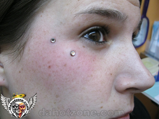 Microdermals