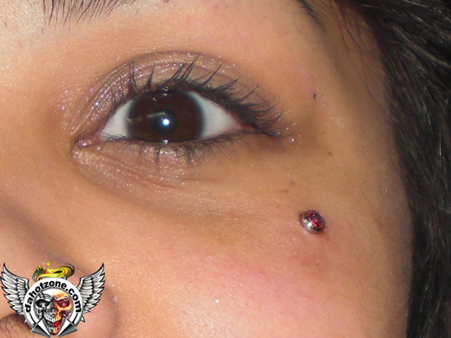 cheek eye microdermal