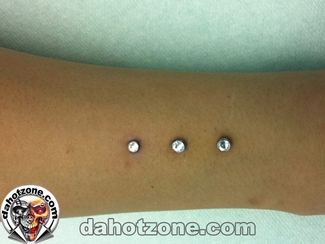 Triple dermal