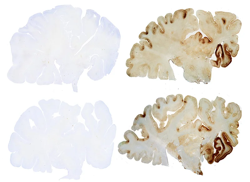 The brain on the right has been diagnosed with CTE.
