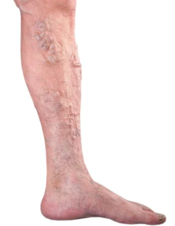 varicose veins