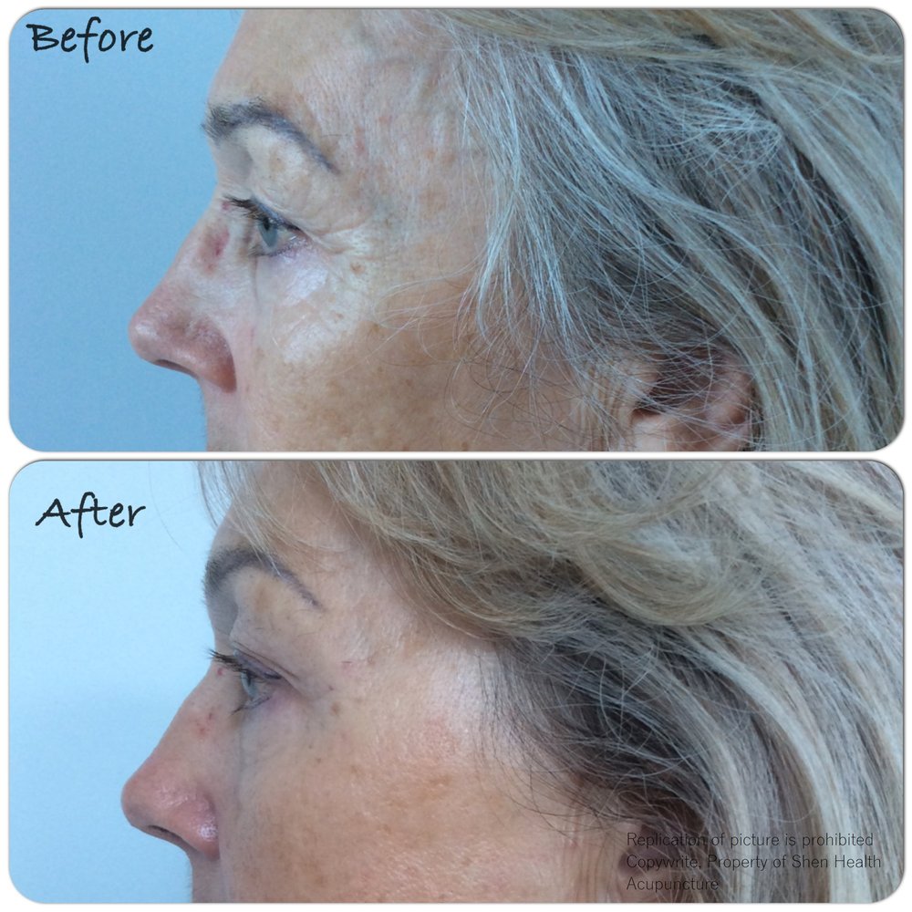 Cosmetic Acupuncture A More Radiant You Shen Health Acupuncture