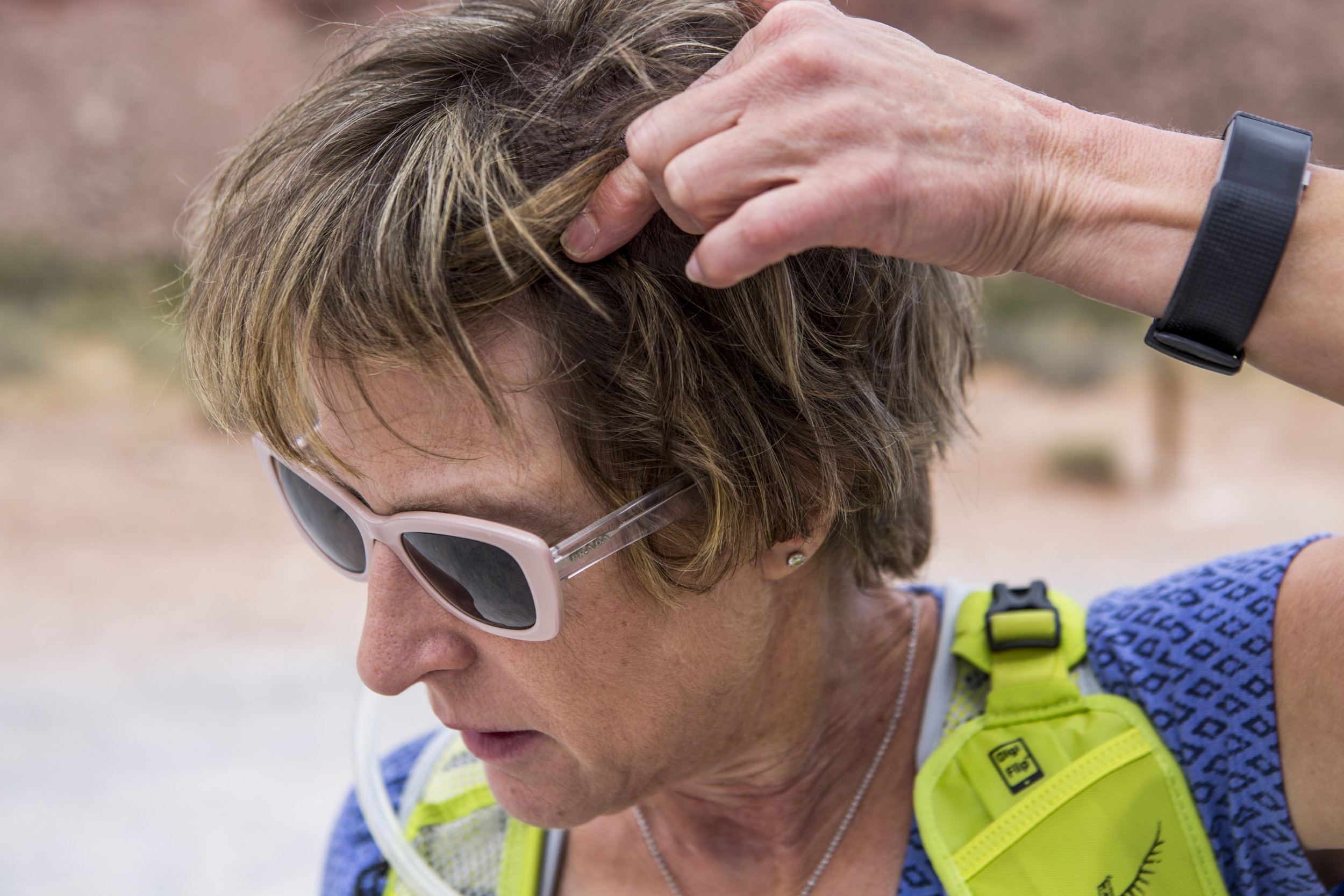  Candace Kawatsu shows where an incision was made in her head in Calico Basin on Thursday, May 18, 2017. Patrick Connolly Las Vegas Review-Journal @PConnPie 