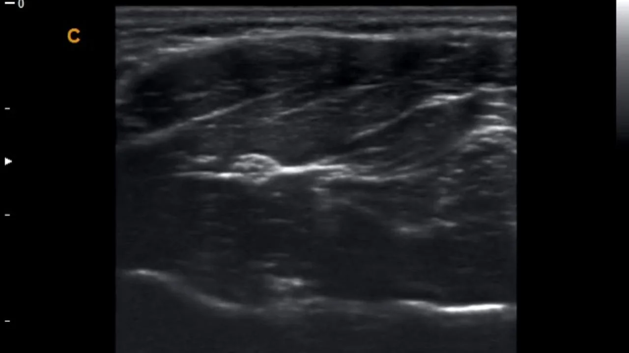 Transverse View of Median Nerve; From UCSF Nerve Atlas
