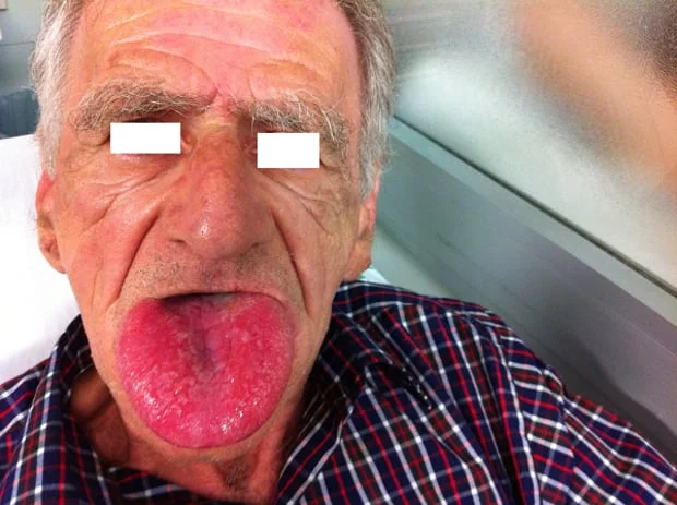 Severe tongue angioedema. Image Courtesy of LITFL .
