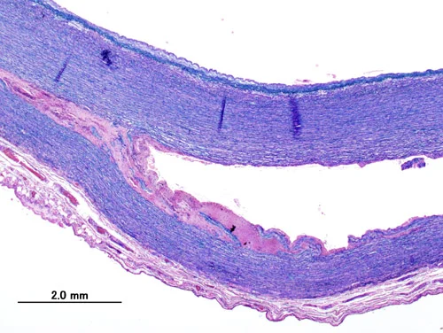 Histopathological image of dissecting aneurysm of thoracic aorta.