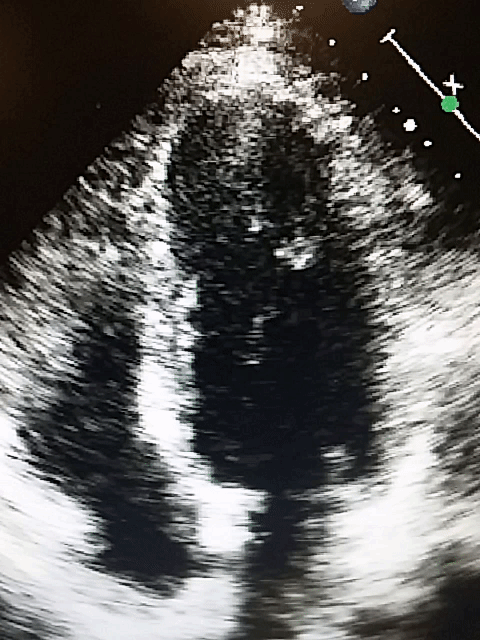 Apical 4-chamber view demonstrating moderate-to-severely depressed LVEF with global hypokinesis without pericardial effusion.