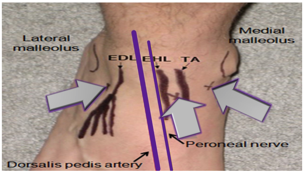 Image 2 : Approaches to the ankle arthrocentesis. (Image modified from: http://img.medscape.com/pi/features/slideshow-slide/arthro-practice/fig9.jpg)