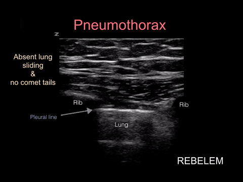 Absence of Lung Sliding