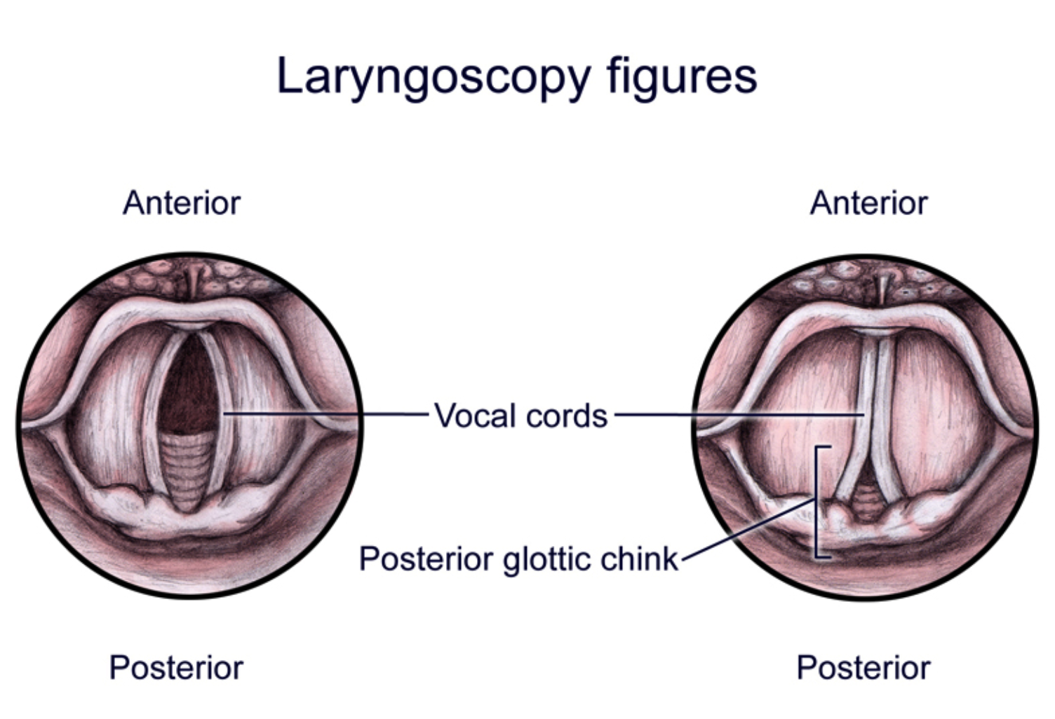 Vocal Cord Dysfunction — NUEM Blog