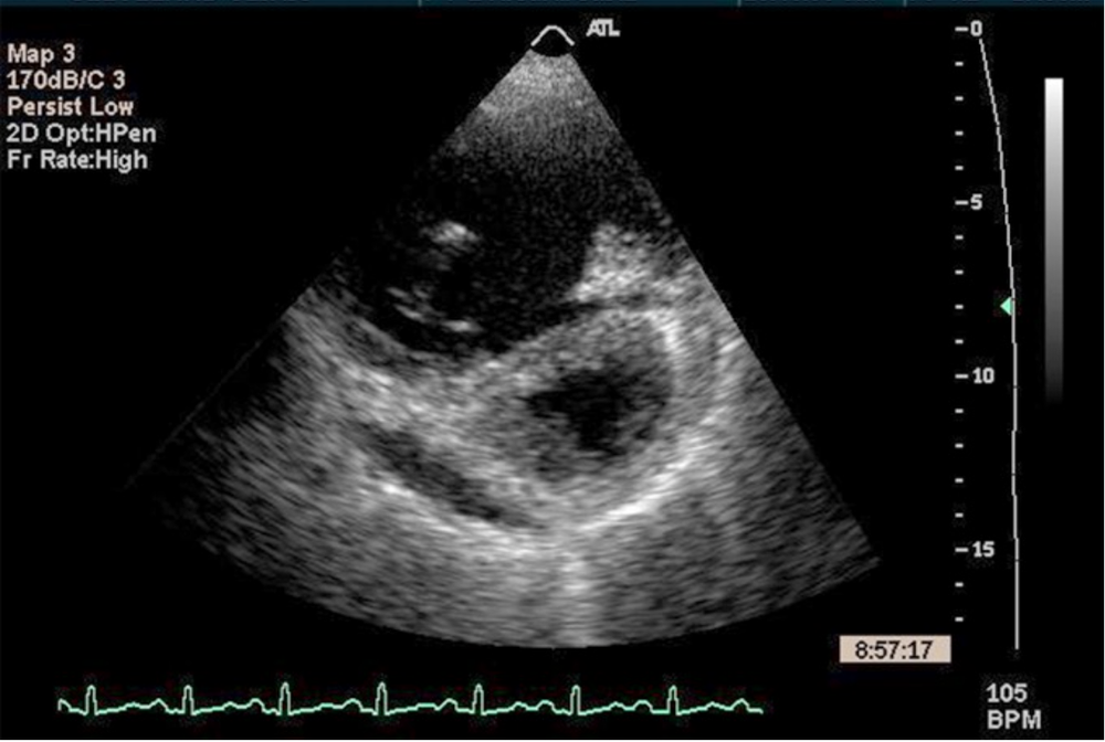 Ask The Expert: Acute Right Ventricular Failure in the ED — NUEM Blog