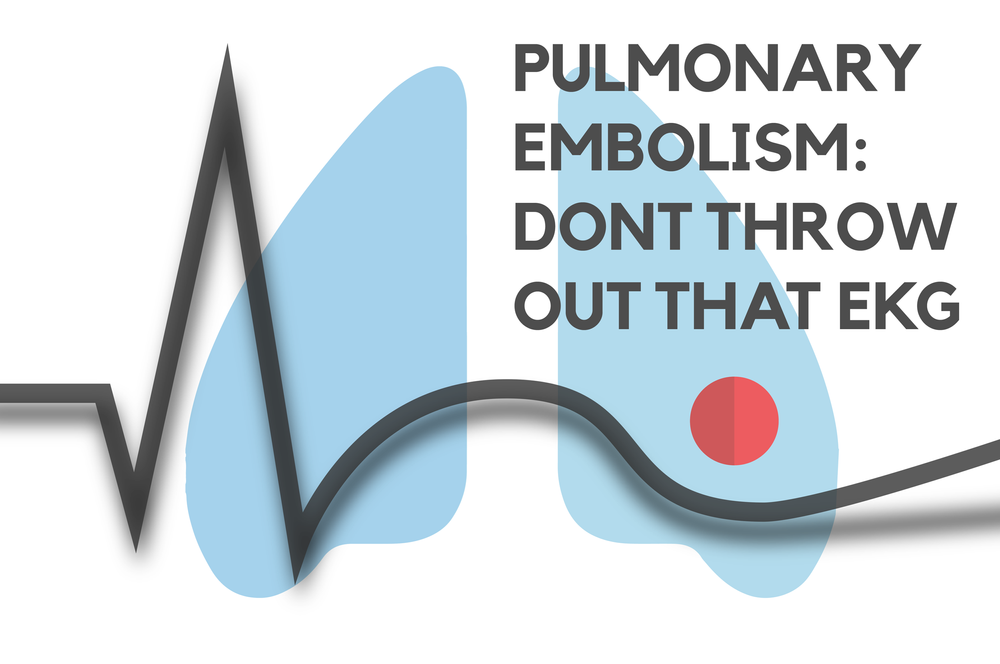 Pulmonary Embolism Don T Throw Out That Ekg Nuem Blog