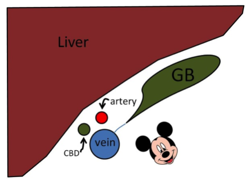 Figure 2 : Short axis diagram, CBD and hepatic artery forming ears of the Mickey Mouse sign with portal vein as Mickey’s head. 