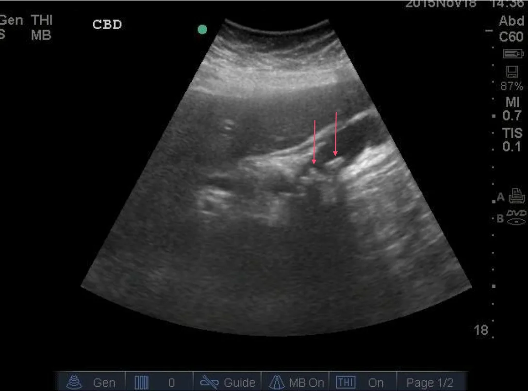 Note multiple shadowing stones within the gallbladder (red arrows).