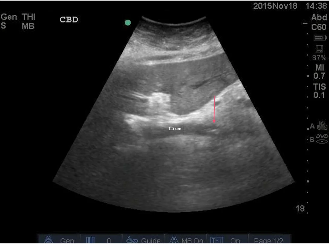 A significantly dilated CBD (white line) is appreciated here. Note the culprit obstructing gallstone is seen to the right of the image (red arrow).