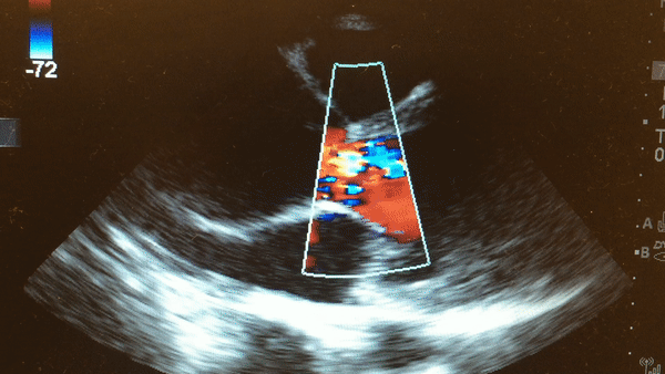 This is a parasternal long axis view demonstrating significant enlargement of the aortic root with severe aortic regurgitation.