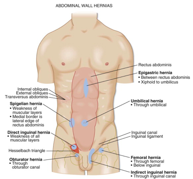 Large Right Inguinal Hernia