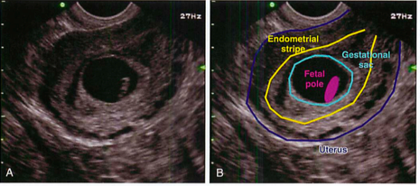A and B: Endovaginal views showing an intrauterine pregnancy. The gestational sac (blue) is located within the endometrial stripe of the uterus (yellow) and contains a fetal pole (purple).