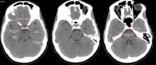The ED Guide to Neuroimaging: Part 1 — NUEM Blog