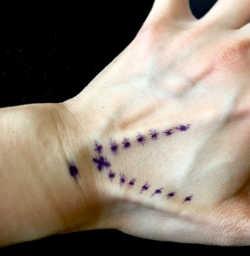 A Visual Guide to Upper Extremity Joint Aspirations — NUEM Blog