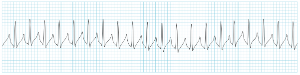 https://lifeinthefastlane.com/ecg-library/svt/
