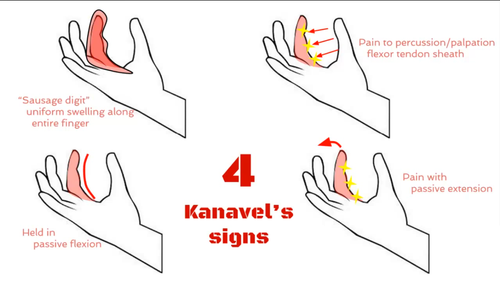 Karaval Sign Flexor Tenosynovitis — NUEM Blog