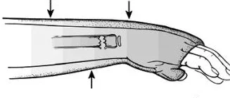 Splinitng Incision Visual Guide to Splinting — NUEM Blog