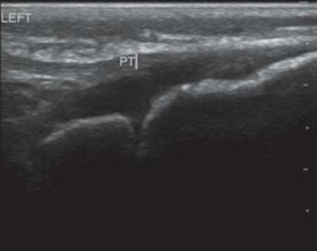 Normal open tibial physis (Crosby et. al. 2014)
