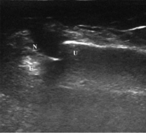Ultrasound in Pediatric Distal Forearm Fractures — NUEM Blog