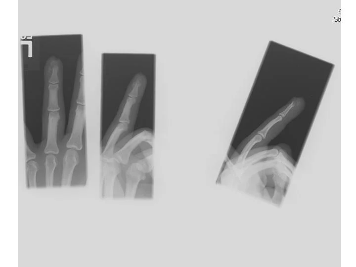 Crush injury to the finger — NUEM Blog