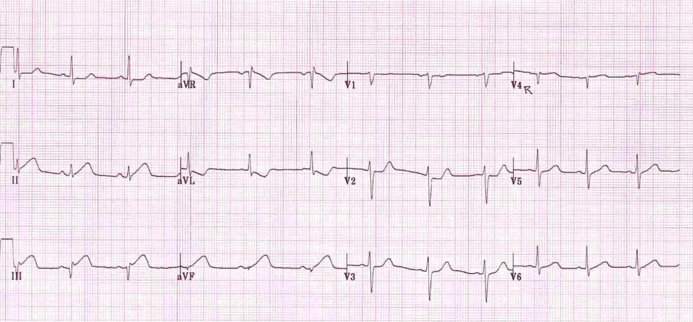 Image from Edward Burns, MD. https://lifeinthefastlane.com/ecg-library/basics/inferior-stemi/