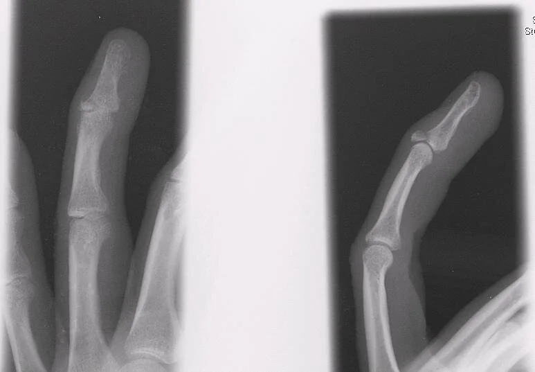 Jammed finger — NUEM Blog