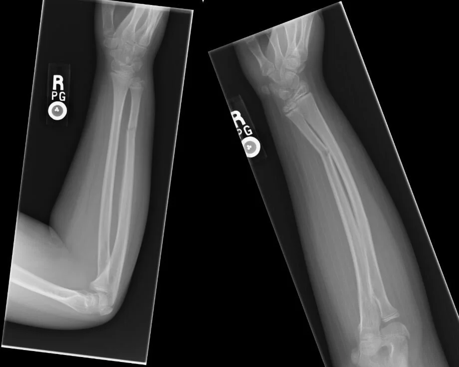 Images Of Greenstick Fracture / Huge collection, amazing choice, 100