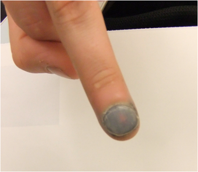Finger hit with hammer — NUEM Blog