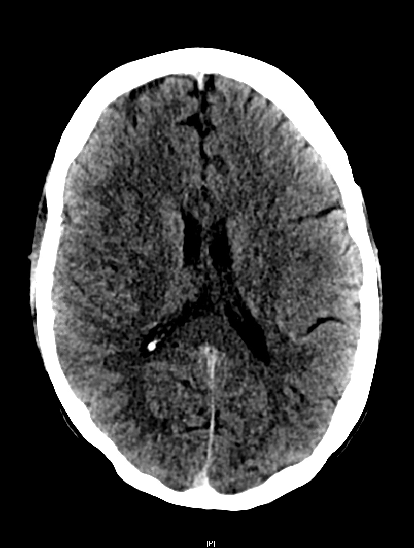 Emergency Guide To Stroke Neuroimaging NUEM Blog