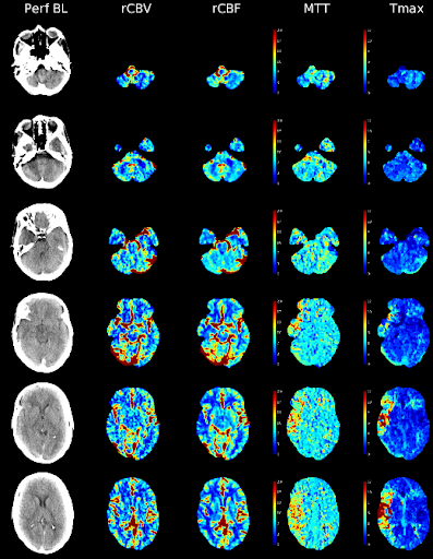 Emergency Guide to Stroke Neuroimaging — NUEM Blog
