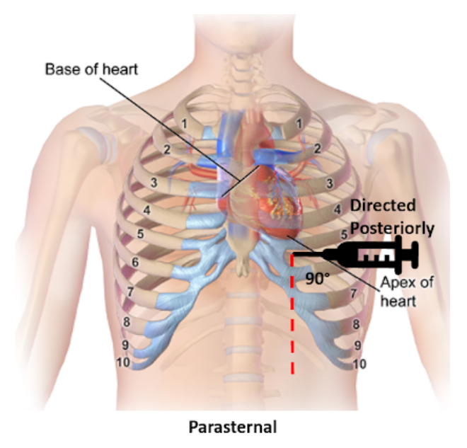 Pericardiocentesis — NUEM Blog