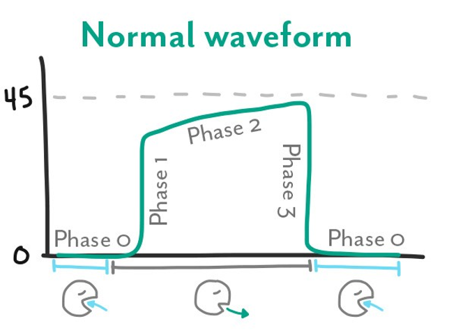 Basic Capnography Interpretation — NUEM Blog