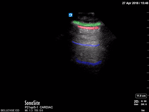 Green = Subcutaneous tissue. Red = Pleural space. Blue = A - lines.