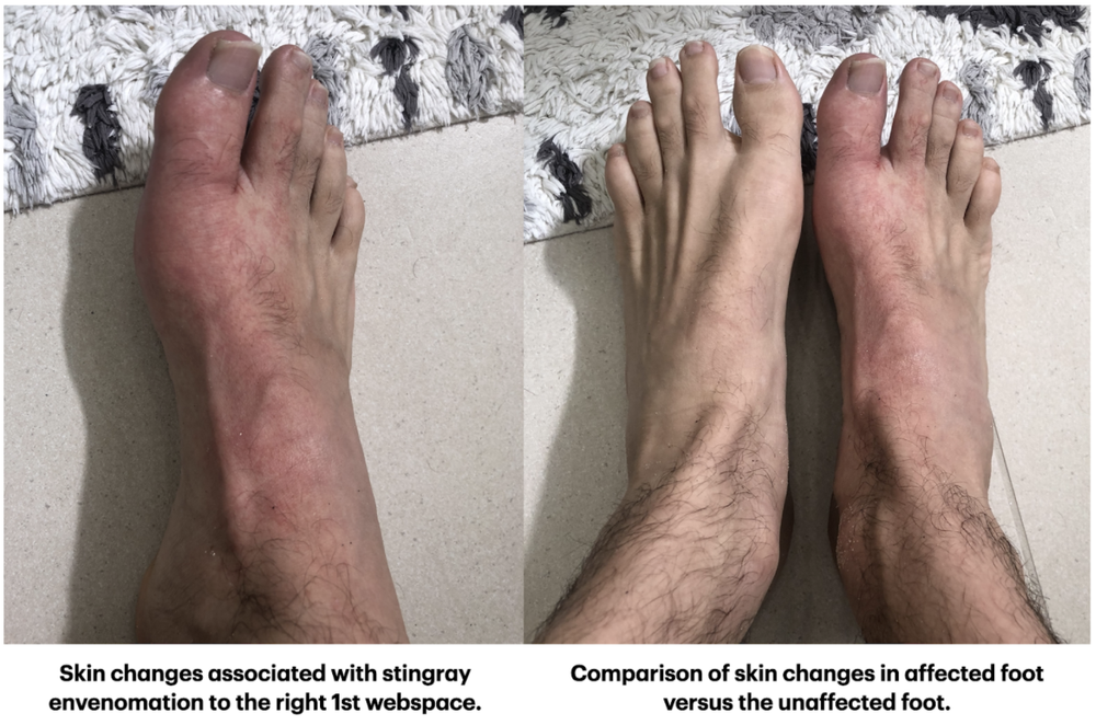 Stingray Stings — NUEM Blog