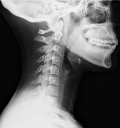In whiplash, the neck straightens from its normal curvature. This change results in the joints wearing out faster.