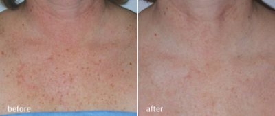 Fotofacial~RF~-~skin~rejuvenation~3.jpg