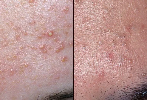 acne.jpg