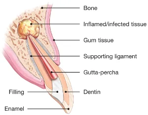 Root-Canals-Explained.jpg