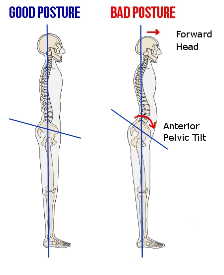 Excessive forward head and shoulder position, along with an excessive anterior pelvic tilt have been associated with increased risk for spine and shoulder pain
