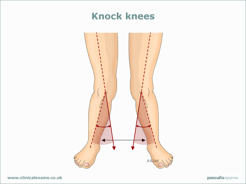 Genu valgum (knock knees) and pes planus (flat feet) are associated with increased risks for lower extremity overuse injuries